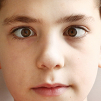 ניתוח פזילה בילדים: כיוון חדש לשרירי העיניים